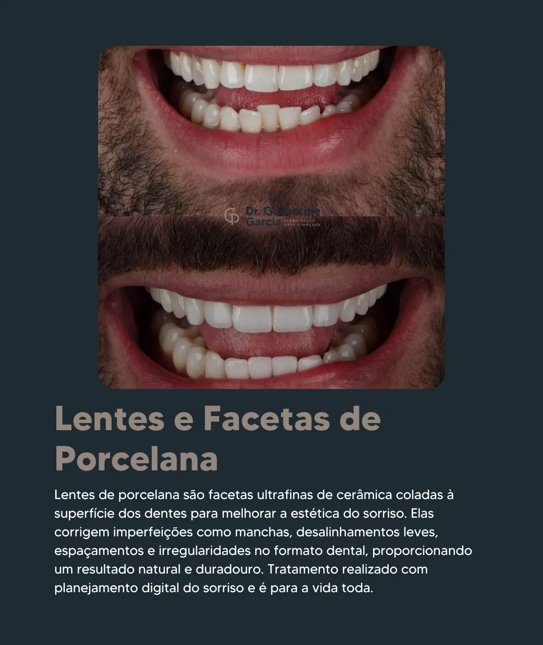 Lentes e Facetas de Porcelana 1080 (OT)
