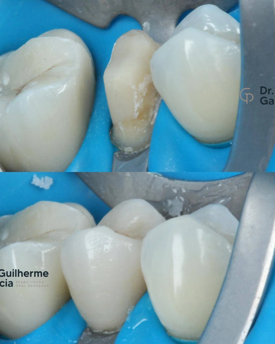 Restauração dentaria (OT) DOWN