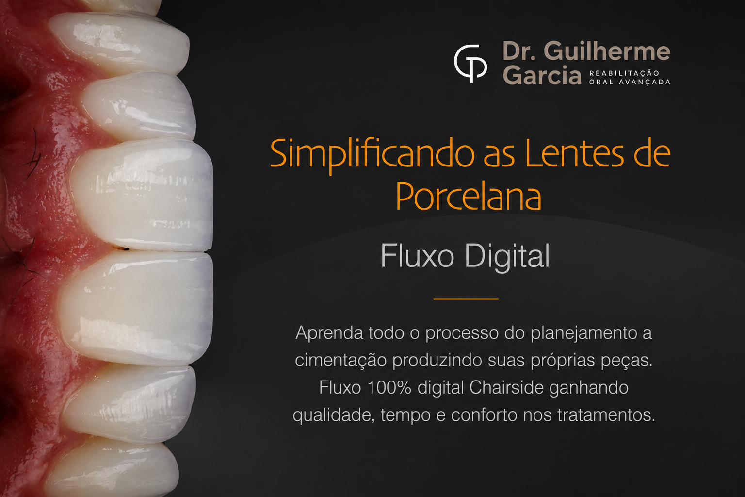 Simplificando as lentes de porcelana. Dr Guilherme Garcia